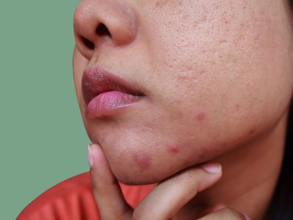 Can Insulin Resistance Affect Your Skin? The Overlooked Acne Connection 2 image 1