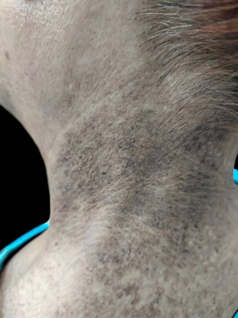 Can Insulin Resistance Affect Your Skin? The Overlooked Acne Connection 3 image 2